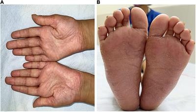 Case report: Corticosteroids as an adjunct treatment for the management of liver abscess in Papillon–Lefèvre syndrome: A report on two cases